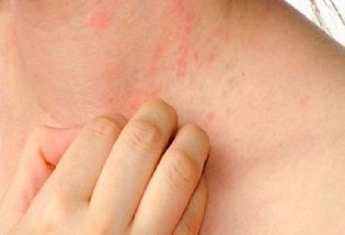 Measles disease लहान मुलांमध्ये गोवर आजार