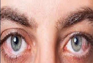 What is blepharitis डोळे येणे म्हणजे काय? हा आजार कसा होतो? त्याची लक्षणं काय?